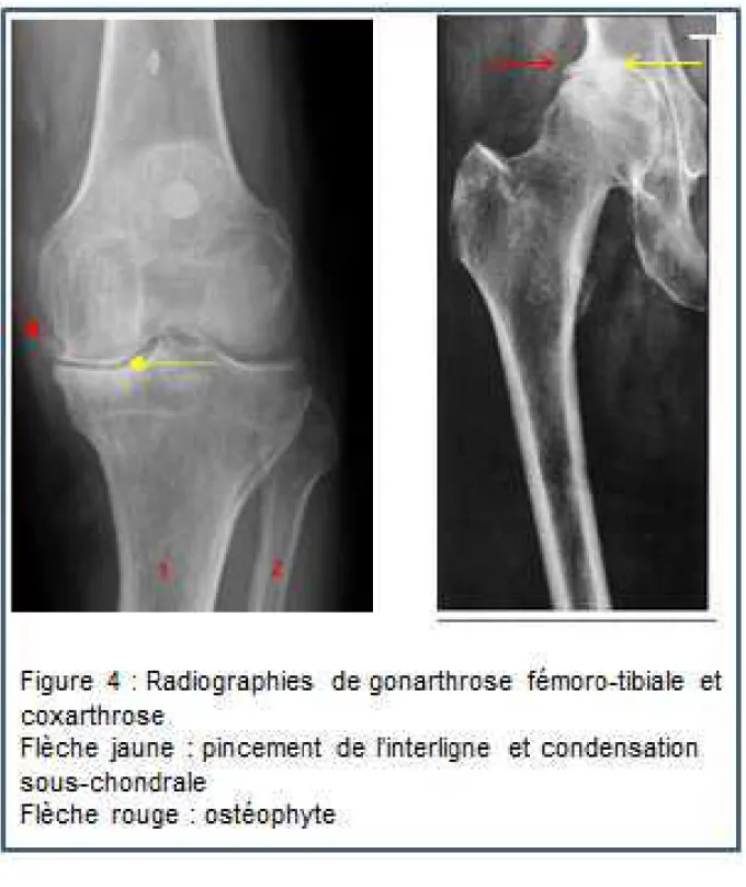 Tableau 3 : Stades de Kellgren et Lawrence pour l’arthrose de hanche (coxarthrose)  et l’arthrose de genou (gonarthrose)