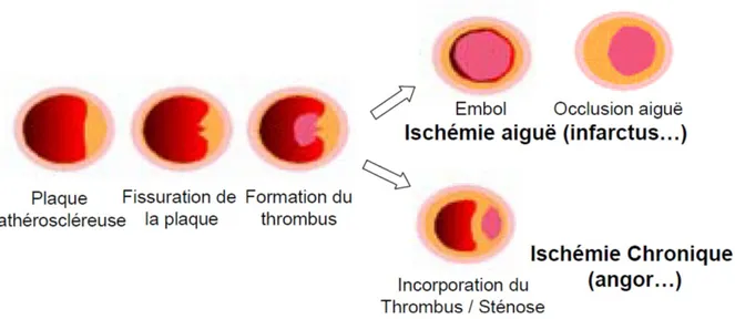 Figure -7- :  Etapes de déclenchement de la thrombose coronaire. 