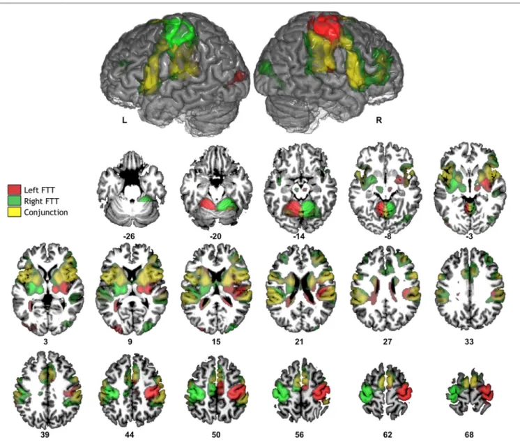 FIGURE 2 | Significant fMRI average activation pattern during left FTT (red), right FTT (green), and their conjunction analysis (yellow) among the 284 participants