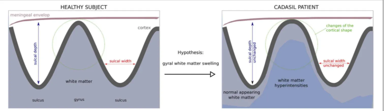 FIGURE 1 | Hypothesis of a gyral white matter swelling in CADASIL and its consequences on the cortex shape