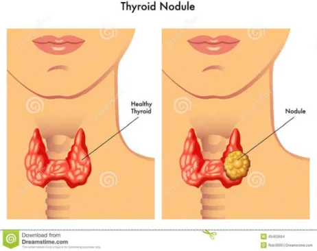 Figure 10.  Nodule thyroïdien. (ID 45417724 © Rob3000 | Dreamstime.com) 