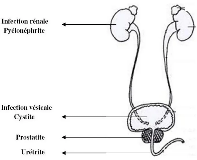 Figure 02 : Forme topographique de type d’infection urinaire (Boutoille ,2011) 