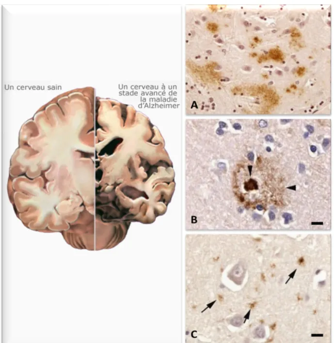 Figure  2:  Lésions macroscopiques et aspects des différents  dépôts amyloïdes  (d’après Duyckaerts et al., 2009)