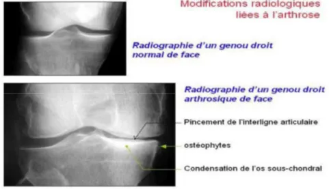 Figure 8 : Modifications radiologiques liées à l'arthrose 