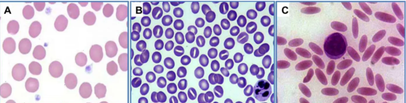 Figure 15 . Dysfonctionnements de la protéine associés à des pathologies érythrocytaires chez l’homme.