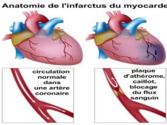 Figure 4 :  anatomie de l’infarctus du myocarde