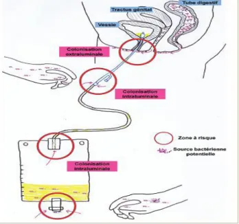 Figure 29 : Principales voies d’acquisitions des MO lors d’un sondage vésical                 (Bakini et  Nigri, 2014)