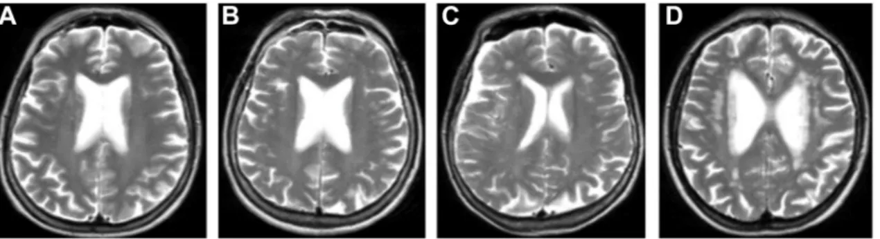 Figure 1  Four T2-weighted MRI images showing the extent of white matter lesions (WML) in each quartile of total WML  volume. The T2-weighted MRI images show four separate individuals by total WML volume, (A) first quartile of WML volume (0–