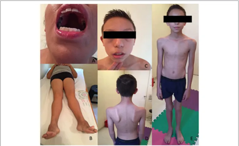 FIGURE 1 | Patients features. P1, exanimated at the age of 44 years, presented a high arched palate (A), a genu valgum and bilateral pes cavus (B)