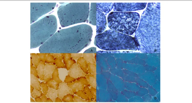 FIGURE 2 | Muscle morphological studies. P1 left deltoid muscle biopsy at 34 years showed the presence of enlarged mitochondria with uneven distribution evident with Gomori trichrome staining (mGT) (A)