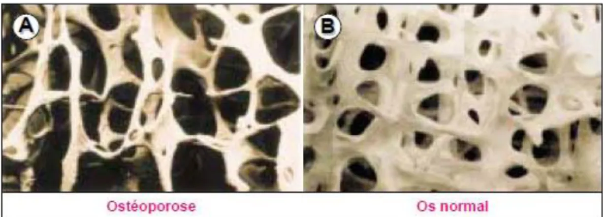 Figure 1: Diminution de l’épaisseur des travées osseuses et perte de leur interconnexion chez  les patients ostéoporotiques (Delmas, 2002) 