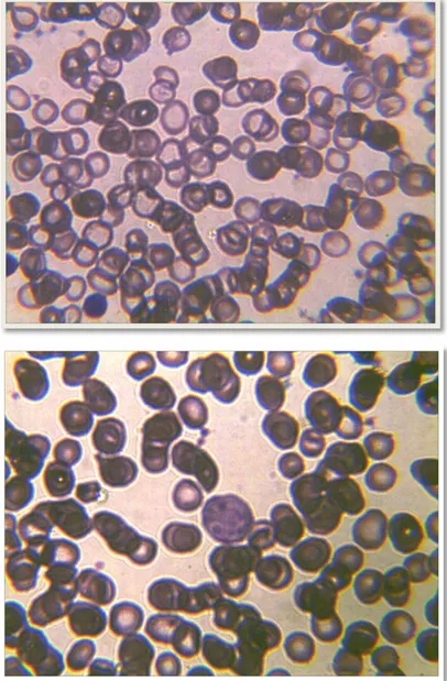 Figure N°16 : frottis de l’anémie hypochrome microcytaire. 
