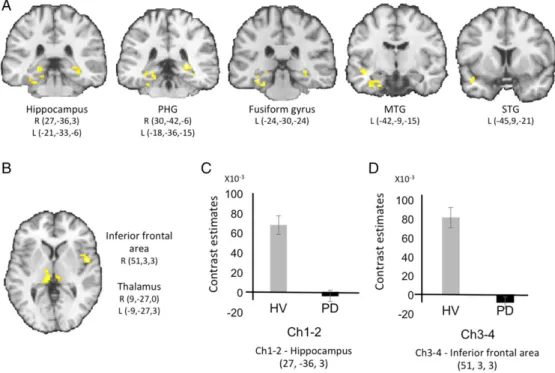 FIG. 2. Results of the functional connectivity analysis. PD patients showed reduced functional connectivity (A) between Ch1-2 and the hippocampus, the parahippocampal gyrus, the middle and superior temporal gyri and the fusiform gyrus, and (B) between Ch3-