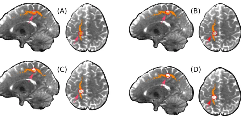 Figure 3: Lesions were simulated in a specific region (red circle) by mixing isotropic diffusion signal within the region