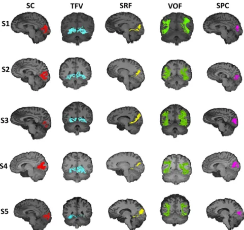 Fig. 7 Intralobar ﬁ bers in the occipital lobe presented in individual subjects. Representation of the identi ﬁ ed occipital intralobar tracts in ﬁ ve of the 24 subjects used in this study