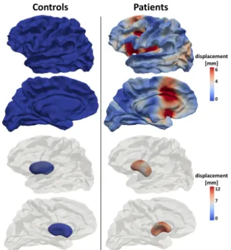 Fig. 9. Typical grey matter configurations for controls and patients. They are obtained by deforming the grey matter structures of the template complex along the most discriminative deformation axis in the space of the initial  mo-menta of the second diffe