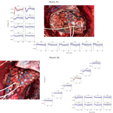 Fig. 2: Placement of ECoG electrodes and sample recordings of the CCEP prop- prop-agation