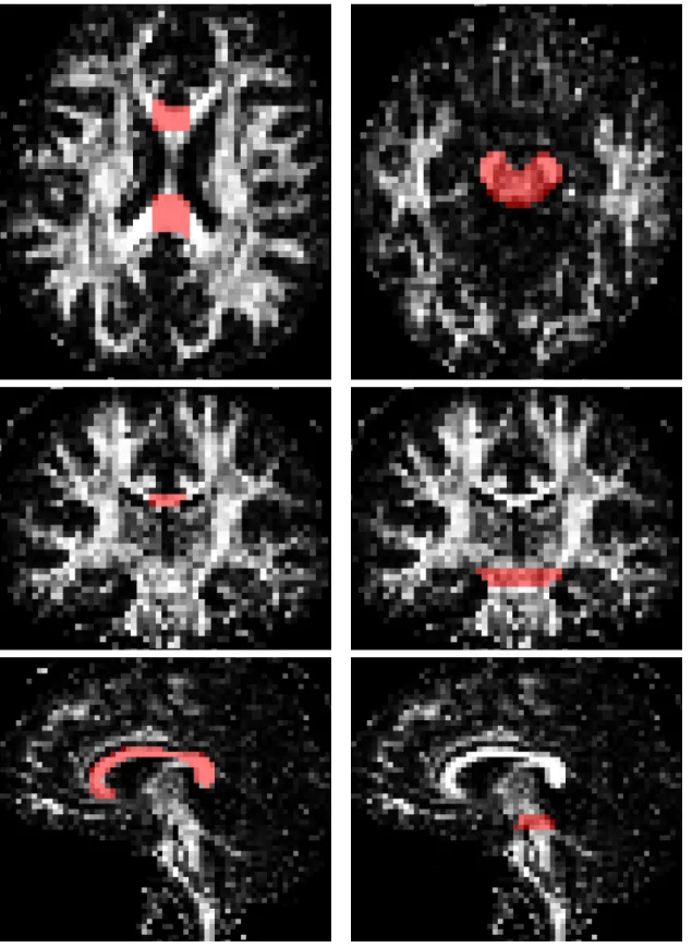 Figure 9: ROI used for tractography on a real dataset. Left: Corpus Callosum.