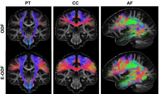 Figure 7 shows segmentations of PT, CC, and AF bundles of interest with a prob-