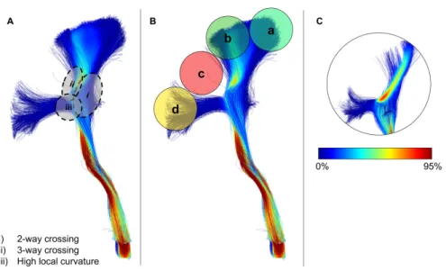 Figure 2: Reconstruction of pyramidal tract (PT) streamlines illustrating some of the challenges of tractography, seen on panel A, i) 2-way crossing ii) 3-way crossing, and iii) high curvature