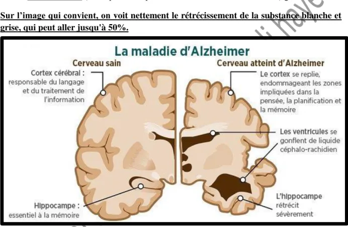 Figure 7: Comparaison entre un cerveau sain et un cerveau atteint d’Alzheimer 