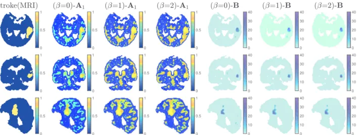 Fig. 6. From left to right: Transversal, coronal and sagital planes (top to bottom) of MRI ground truth of the stroke zone, factor proportions (A 1 ) from specific gray matter and variability matrices (B) obtained with β-SLMM for β = 0,1,2.