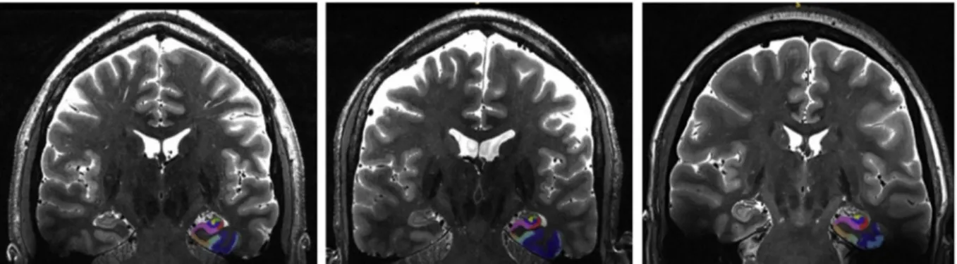 Fig. 2. Sample T1-weighted scans and Freesurfer segmentation across sites. (A) Sample T1-weighted scans from two different sites (top: Pisa [GE], bottom: