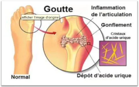 Figure n°11: Schéma représentant une crise de goutte touchant [84] 