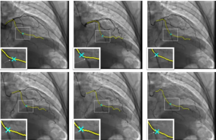 Figure 2 – Résultats du suivi temporel pour un patient sur un cycle cardiaque. La courbe jaune représente la  pro-jection du vaisseau 3D, la croix bleue le point suivi comme étant la bifurcation, et la flèche blanche désigne la vraie bifurcation