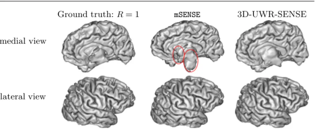 Fig. 3 Gray matter surface extraction based on reconstructed slices using mSENSE and 3D- 3D-UWR-SENSE for R = 4