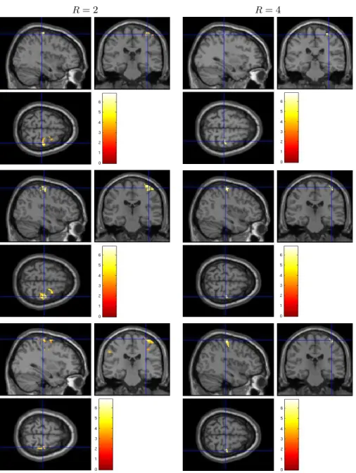 Fig. 7 Student’s t-maps superimposed to anatomical MRI for the Lc-Rc contrast. Data have been reconstructed using the mSENSE (top row), UWR-SENSE (middle row) and  4D-UWR-SENSE (bottom row), respectively