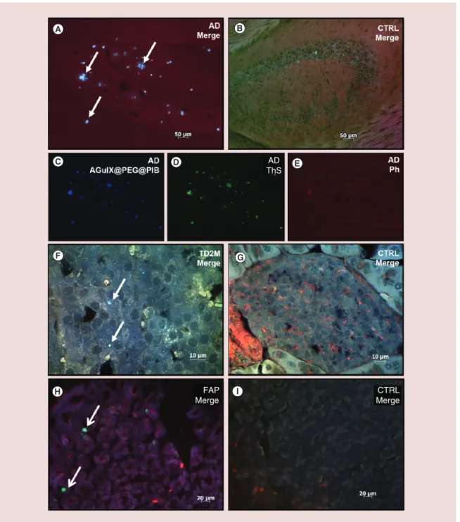 Figure 5. Amyloid deposit targeting with AGuIX@PEG@PIB in pathological tissue. Specific targeting of amyloid  plaques with AGuIX@PEG@PIB nanoparticles on brain sections of APPswe/PSE1d9 mice (A, C–E), on pancreas  sections of S/FVB/N-Tg/(ins2-hIAPP) mice (