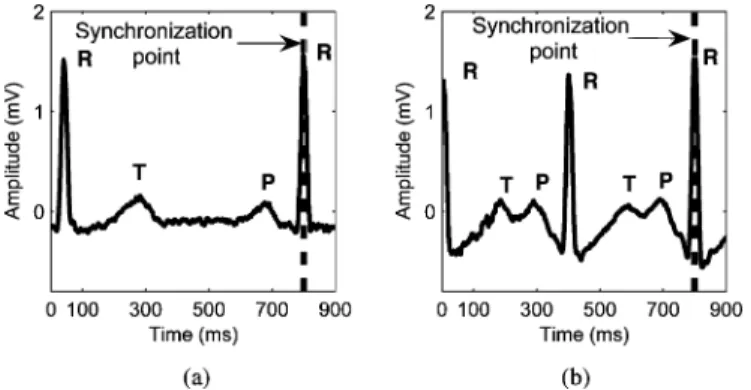 Fig. 1. Example of (a) a real ECG where the T and P waves are disjointed at rest and (b) overlapped during exercise.