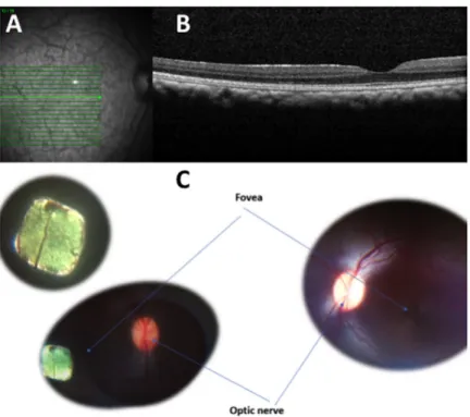Fig 5. Retinal imaging of a subretinal 2mm PRIMA chip implantation in Primate eye before and immediately after surgery