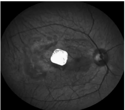 Fig 9. Red-free fundus photograph of in Macaca fascicularis. The 1.5mm implant remains in the central macula at 2 weeks postoperatively.