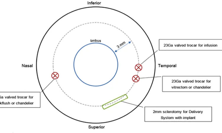 Fig 3. Diagram of vitrectomy instrumentation entry ports.