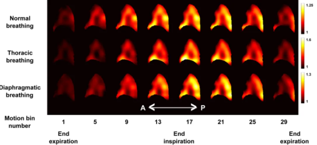 Figure 4.  Coronal views of the different components of the Green-Lagrange strain tensor ε xx G  (along the  superior-inferior direction), ε yyG  (along the left-right direction), ε zzG  (along the anterior-posterior direction), ε xyG ,  ε yzG , and ε xzG 