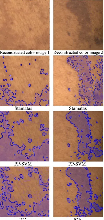 Fig. 2. Detected pathological areas by Stamatas algorithm, by SVM with Projection Pursuit (PP-SVM), and by thresholding the selected ICA component.