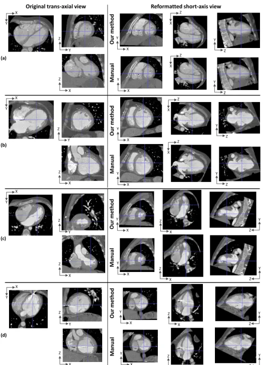 Fig. 3: Example results. On the left, 3 views of original trans-axial images; on the right, 3 views of corresponding short-axis images reformatted with our method (top), and the provided manual reformatting (gold standard) (bottom).