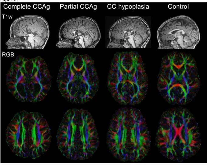 Figure 1: T1w images and DTI-RGB maps in typical children 