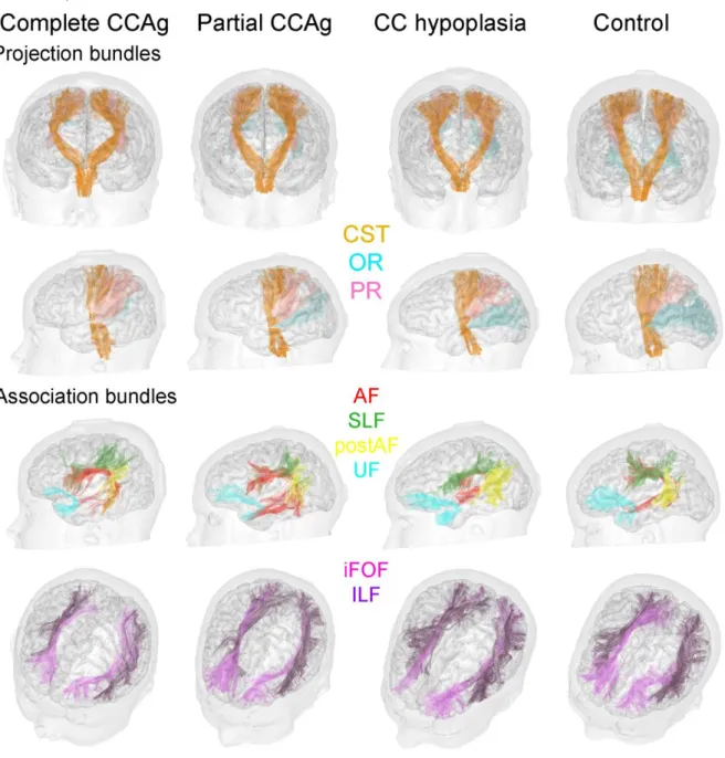 Figure 4: Tractography of the main white matter bundles 