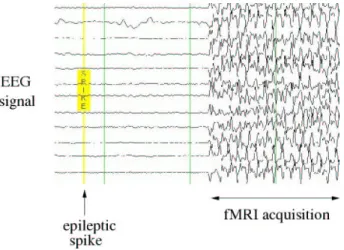 Fig. 2. The EEG signals are continuously monitored. Some fMRI volumes acquisitions are triggered when a spike of epileptic activity is detected