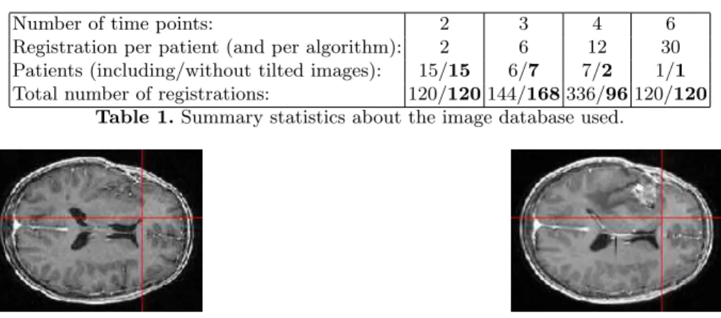 Fig. 2. Example of a slice of two registered images with a high deformation.