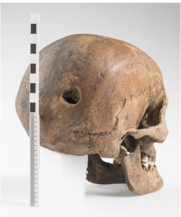Fig 7. The skull of SK259 showing the trepanation hole in the posterior part of the right parietal bone