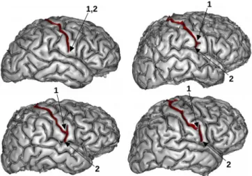 Fig.  2. Where  should  the  central  sulcus end? The  folds  that  may  belong to the cen-  tral  sulcus  are shown in red