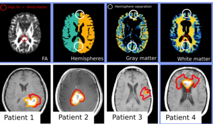 Fig. 3: Top: Data processing using the Fractional Anisotropy (FA) and the hemi- hemi-sphere segmentation to ensure the separation of the hemihemi-spheres in the white and gray matter