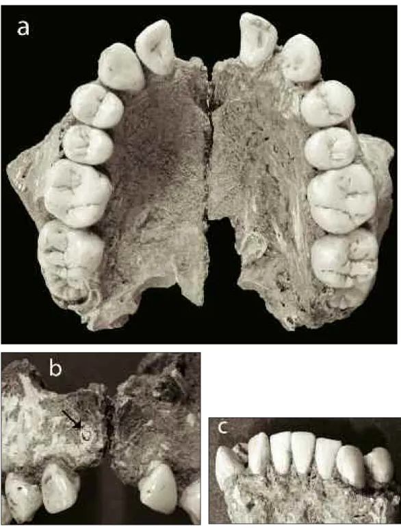 Fig. 2 - Avulsion probable des deux incisives centrales supérieures d'une adolescente du site d’El Wad (EW H28- 32 [12])