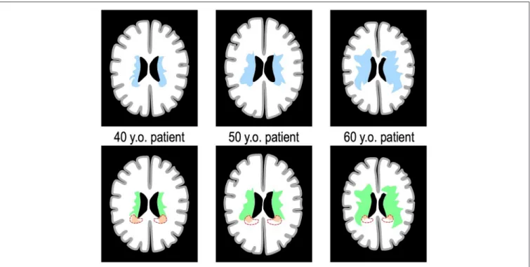 FIGURE 1 | Spatial burden of WMH and the hypothesis of different populations. The schematic represents 3 theoretical patients of increasing age, with on the (Top Line) the masks of the whole burden of WMH overlaid on the same axial brain slice (in blue)
