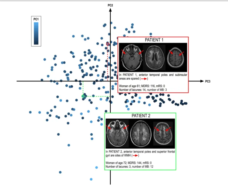FIGURE 3 | Determination of WMH spatial pattern from the values of the different components