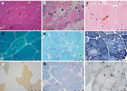 Fig. 3 Histochemical features of myoglobinopathy. a Anterior tibialis muscle biopsy from individual F3, III: 15, 10 years prior to the onset of symptoms, stained with hematoxylin and eosin, showing several rounded brown inclusions (arrows) (sarcoplasmic bo